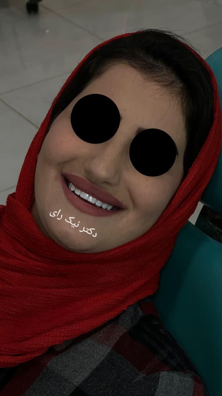 کامپوزیت زیبایی دندان|خدمات آرایشگری و زیبایی|صحنه, |دیوار