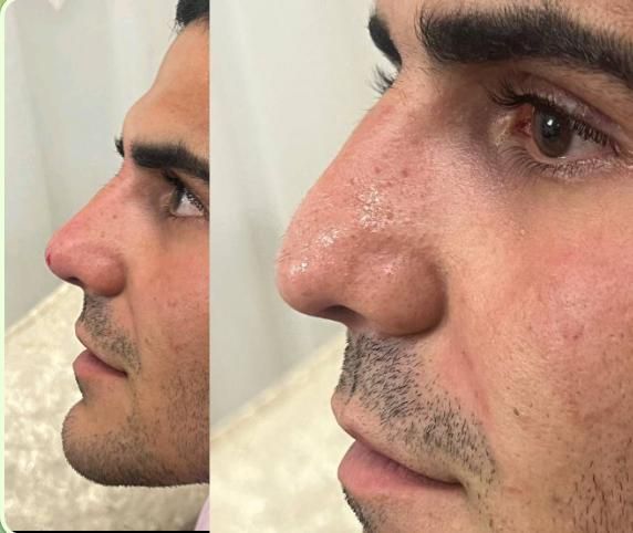 ژل اودری اصل سی سی 350بوتاکس ۵۰۰و خال برداری|خدمات آرایشگری و زیبایی|قم, زنبیل آباد|دیوار