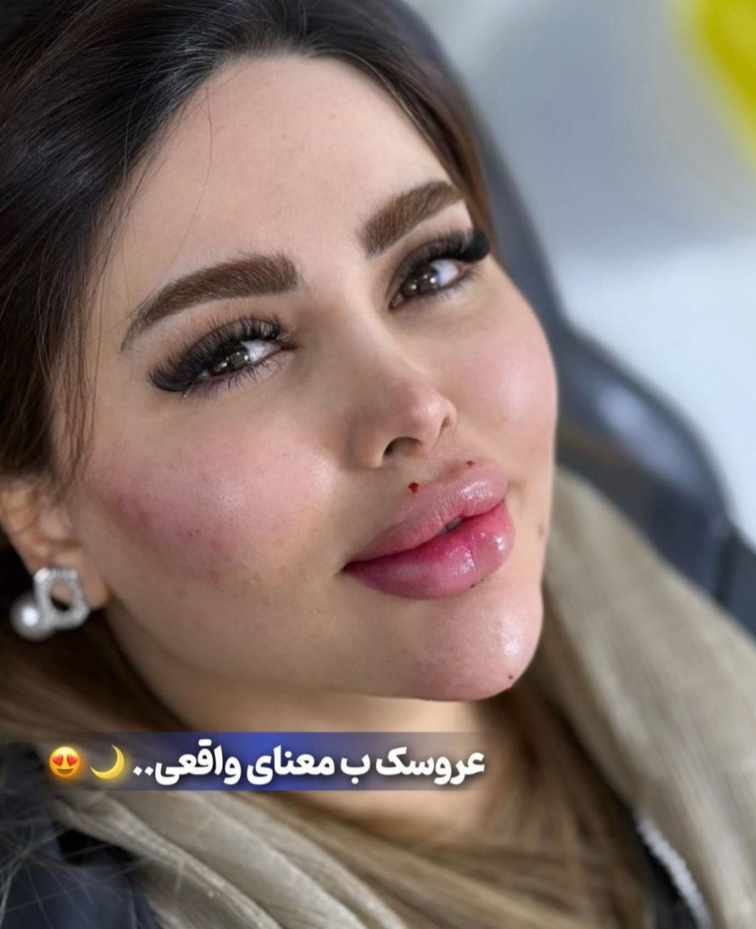 ژل بوتاکس فیلر چربی مزو جوانساز بلفارو درمطب پزشک|خدمات آرایشگری و زیبایی|کرج, گوهردشت|دیوار