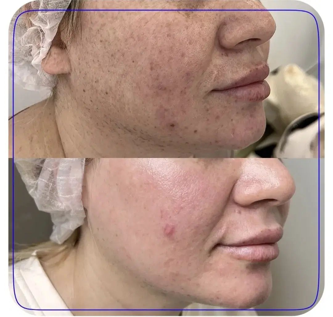فیشیال و پاکسازی تخصصی درمانی ب مدت محدود|خدمات آرایشگری و زیبایی|کرمانشاه, |دیوار