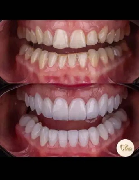 دندانپزشکی و زیبایی بدون پیش پرداخت|خدمات آرایشگری و زیبایی|قم, نوقطار|دیوار