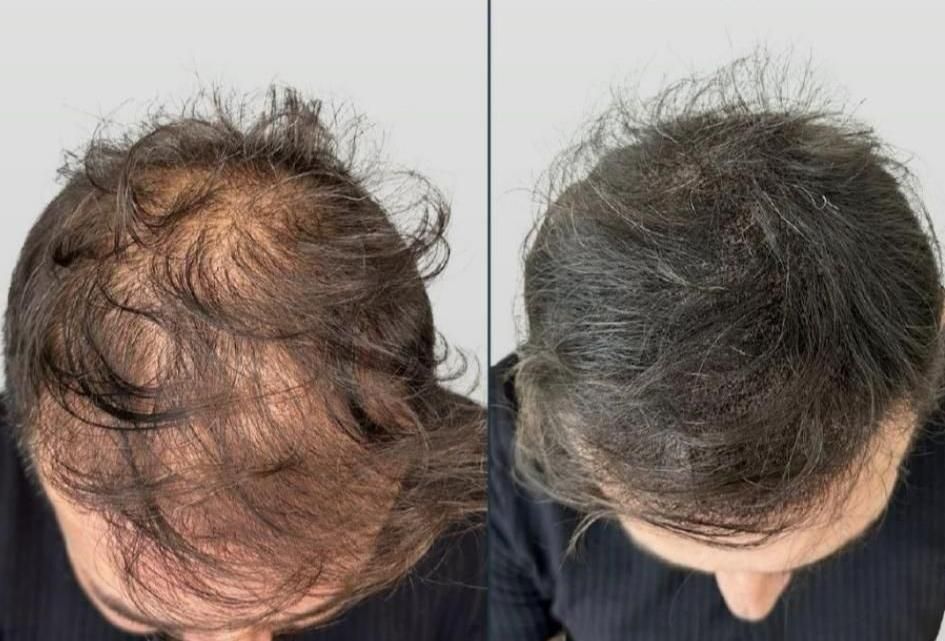 اسکالپ تخصصی در کلینیک پوست مو کاشت میکرو اسکالپ|خدمات آرایشگری و زیبایی|مشهد, شهید فرامرز عباسی|دیوار