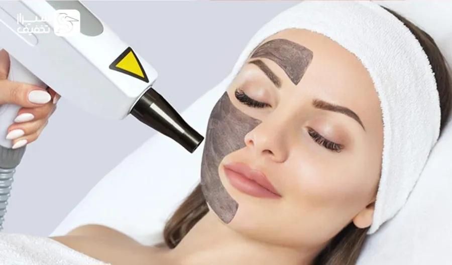 کربن تراپی،روشن کننده نواحی تیره و ریموتتو|خدمات آرایشگری و زیبایی|قم, زنبیل آباد|دیوار