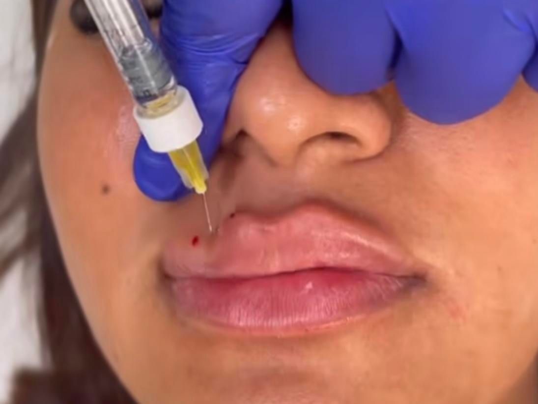 کلینیک تزریق ژل لب روسیm مادلینگ mdبوتاکس لیزر|خدمات آرایشگری و زیبایی|تهران, صادقیه|دیوار