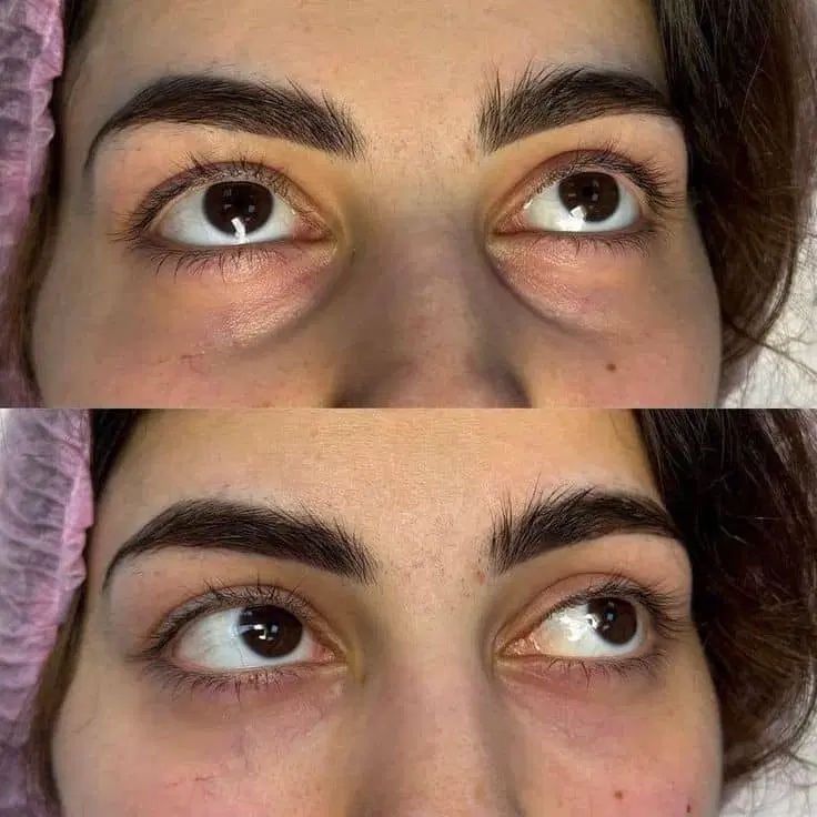 تزریق فیلر بوتاکس فیشال درمان لک جوش چین و چروک|خدمات آرایشگری و زیبایی|محمدشهر, محمدشهر|دیوار