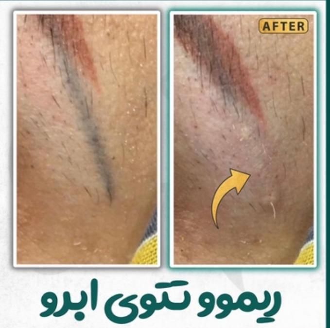 پاک کردن تتو ابرو و ریموو خالکوبی بدن توسط پزشک|خدمات آرایشگری و زیبایی|رشت, گلسار|دیوار