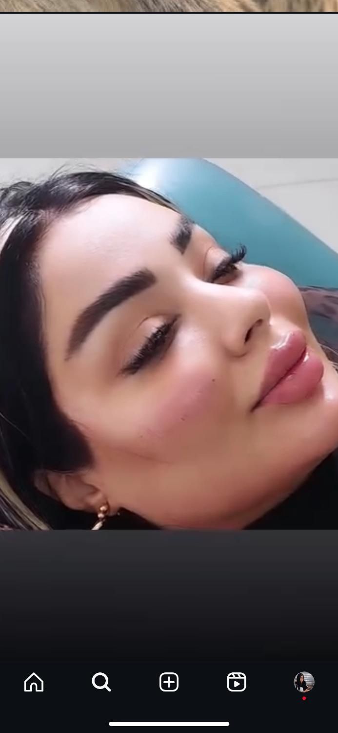 مزو،بوتاکس،چربی،فیلر،جراحی زیبایی صورت وبدن|خدمات آرایشگری و زیبایی|تهران, نارمک|دیوار