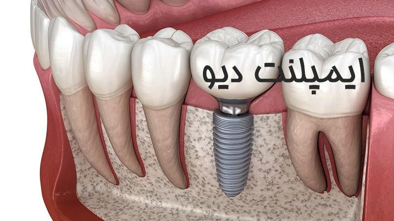 اوردنچر و ایمپلنت فقط پنج و پونصد|خدمات آرایشگری و زیبایی|رشت, کاکتوس|دیوار