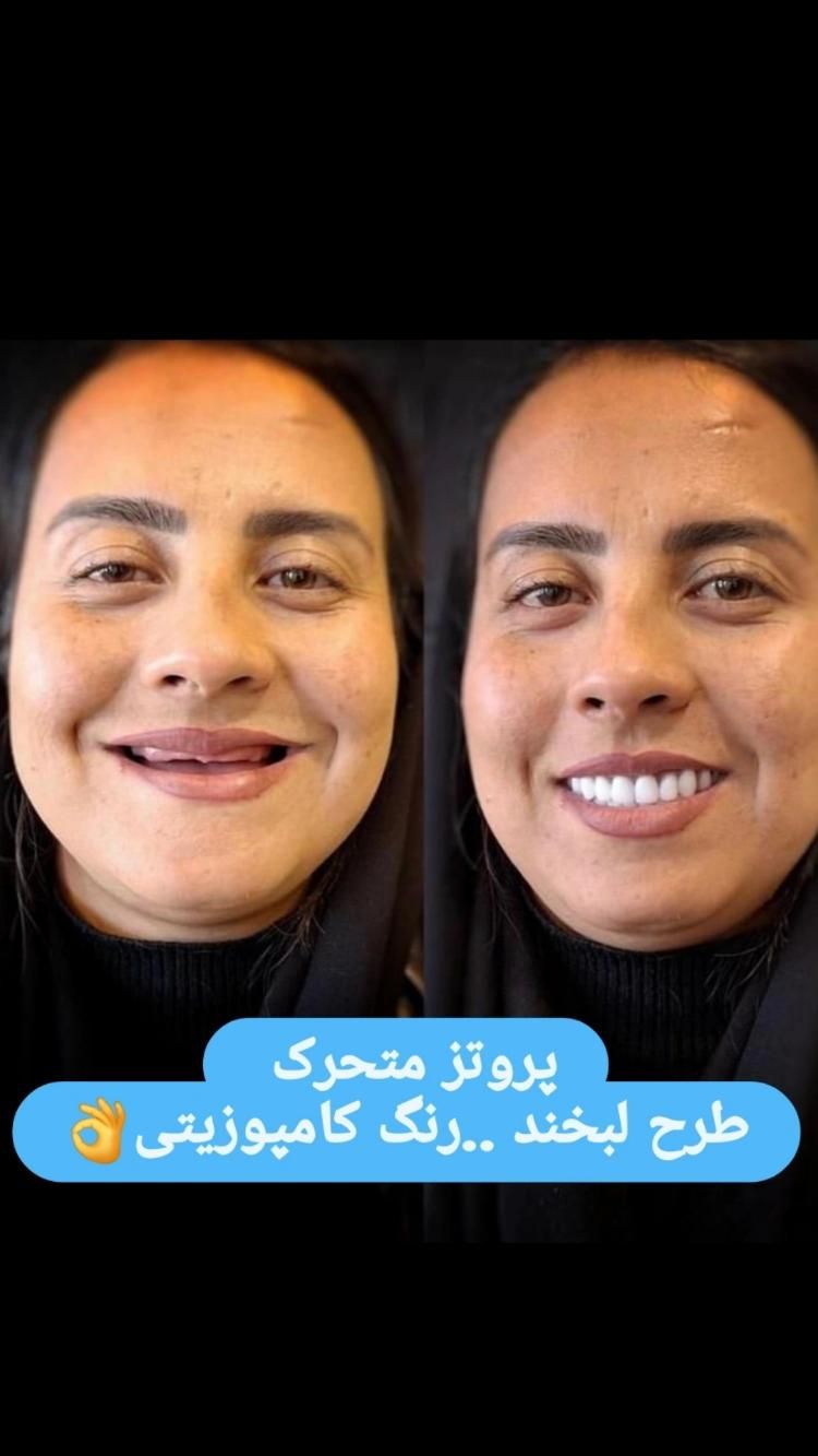 ساخت دندان مصنوعی جلوه طبیعی طرح لبخند|خدمات آرایشگری و زیبایی|سبزوار, امیر کبیر|دیوار