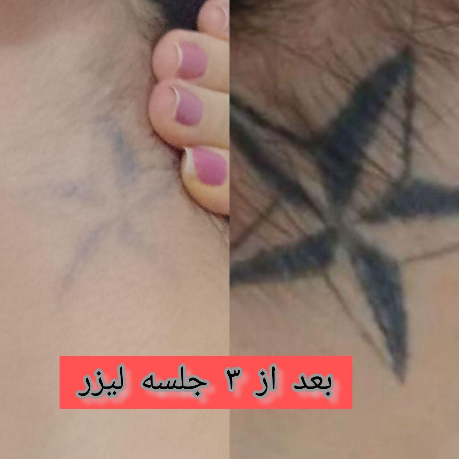 لیزر تاتو و خالکوبی و جوانسازی پوست(کر۰بنتراپی)|خدمات آرایشگری و زیبایی|محمدشهر, |دیوار