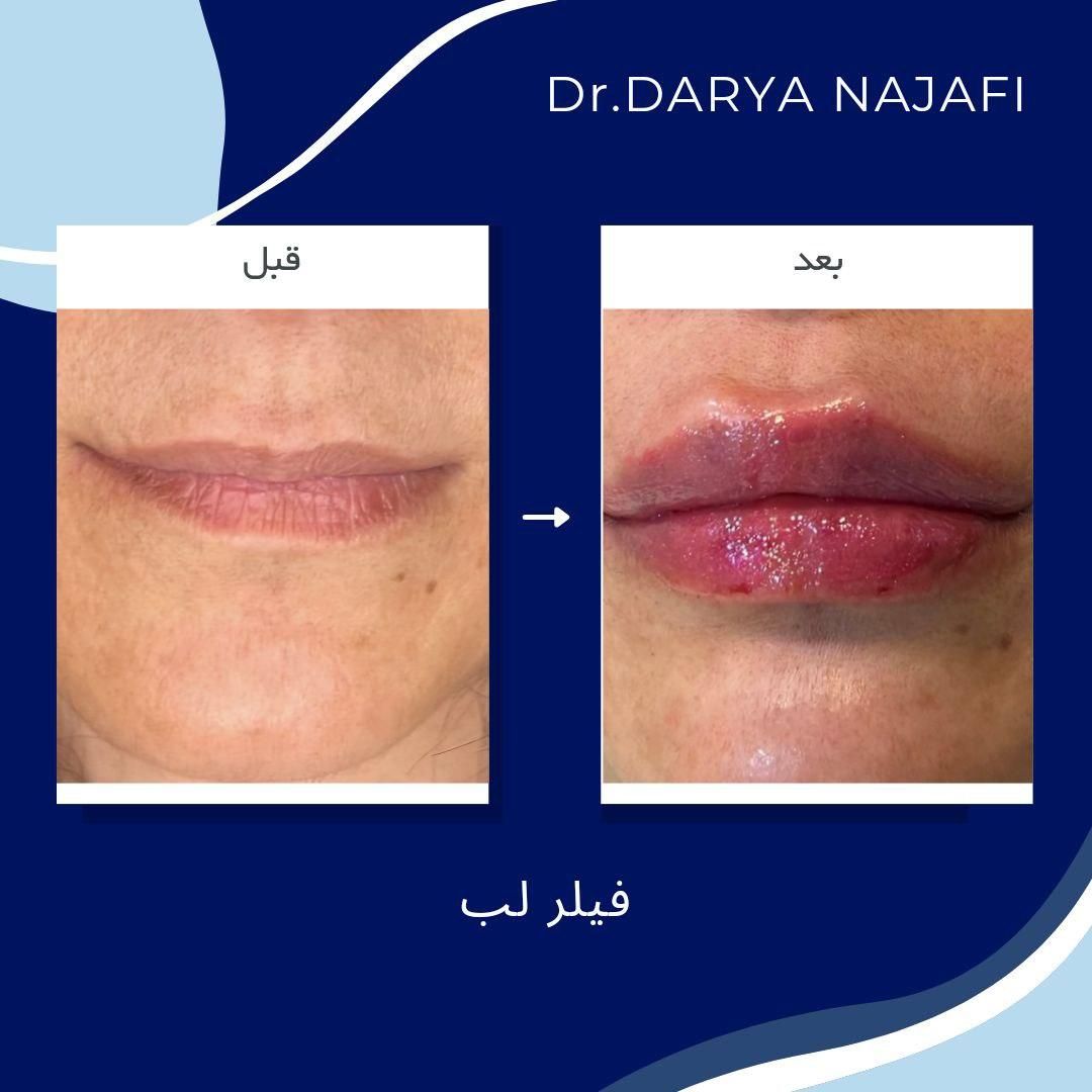 تزریق بوتاکس و فیلر توسط پزشک|خدمات آرایشگری و زیبایی|تهران, شهرک شریعتی|دیوار