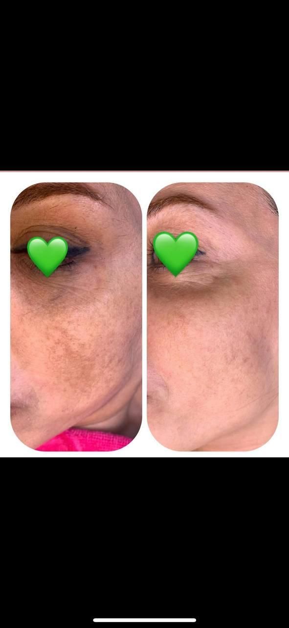 ریمو تتو.کربن ترابی صورت.روشنکردن نواحی تیره|خدمات آرایشگری و زیبایی|قم, باجک دو|دیوار