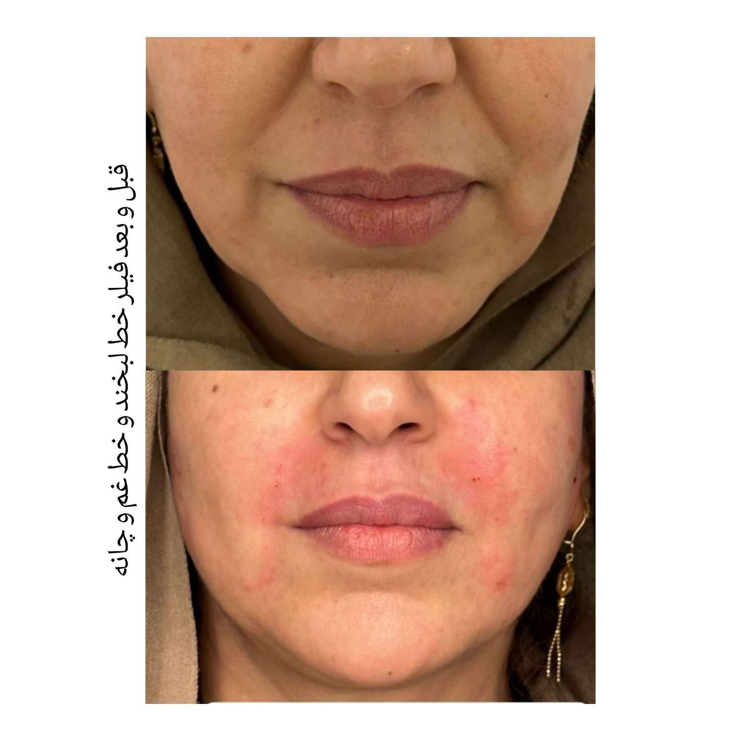 انجام تمامی خدمات فیلر و بوتاکس|خدمات آرایشگری و زیبایی|سبزوار, توحیدشهر|دیوار