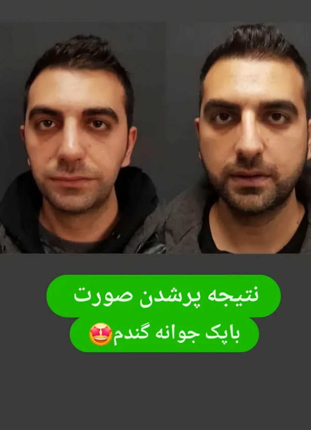 تپلی صورت|آرایشی، بهداشتی، درمانی|رشت, بلوار گیلان|دیوار