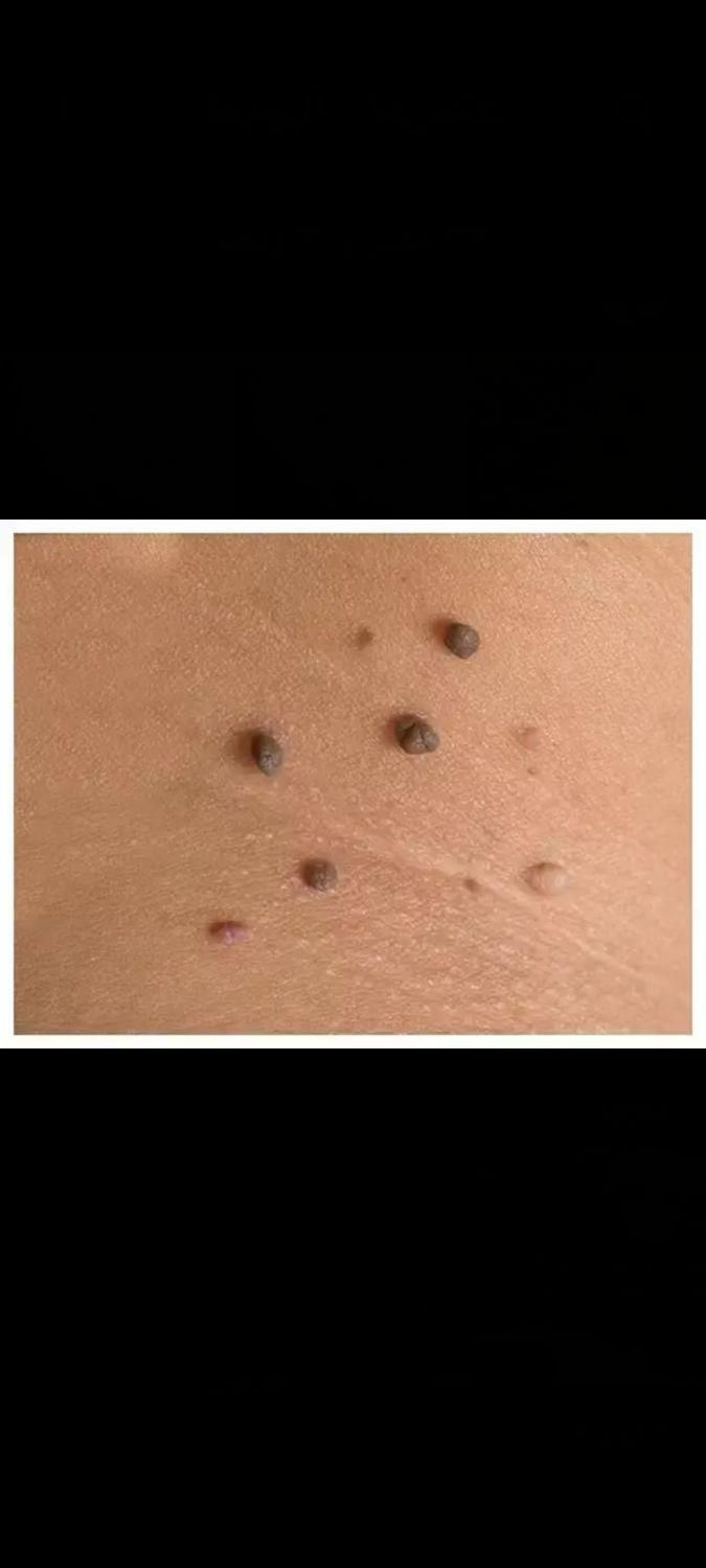 درمان قطعی زگیل و تبخال با ضمانت|آرایشی، بهداشتی، درمانی|کرمانشاه, |دیوار