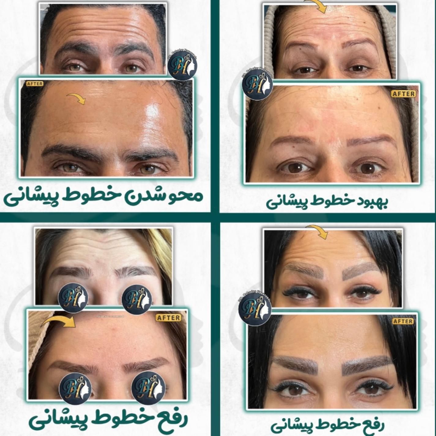 بوتاکس فیلر(ژل) مزوتراپی، پی ار پی درمطب گلسار رشت|خدمات آرایشگری و زیبایی|رشت, گلسار|دیوار