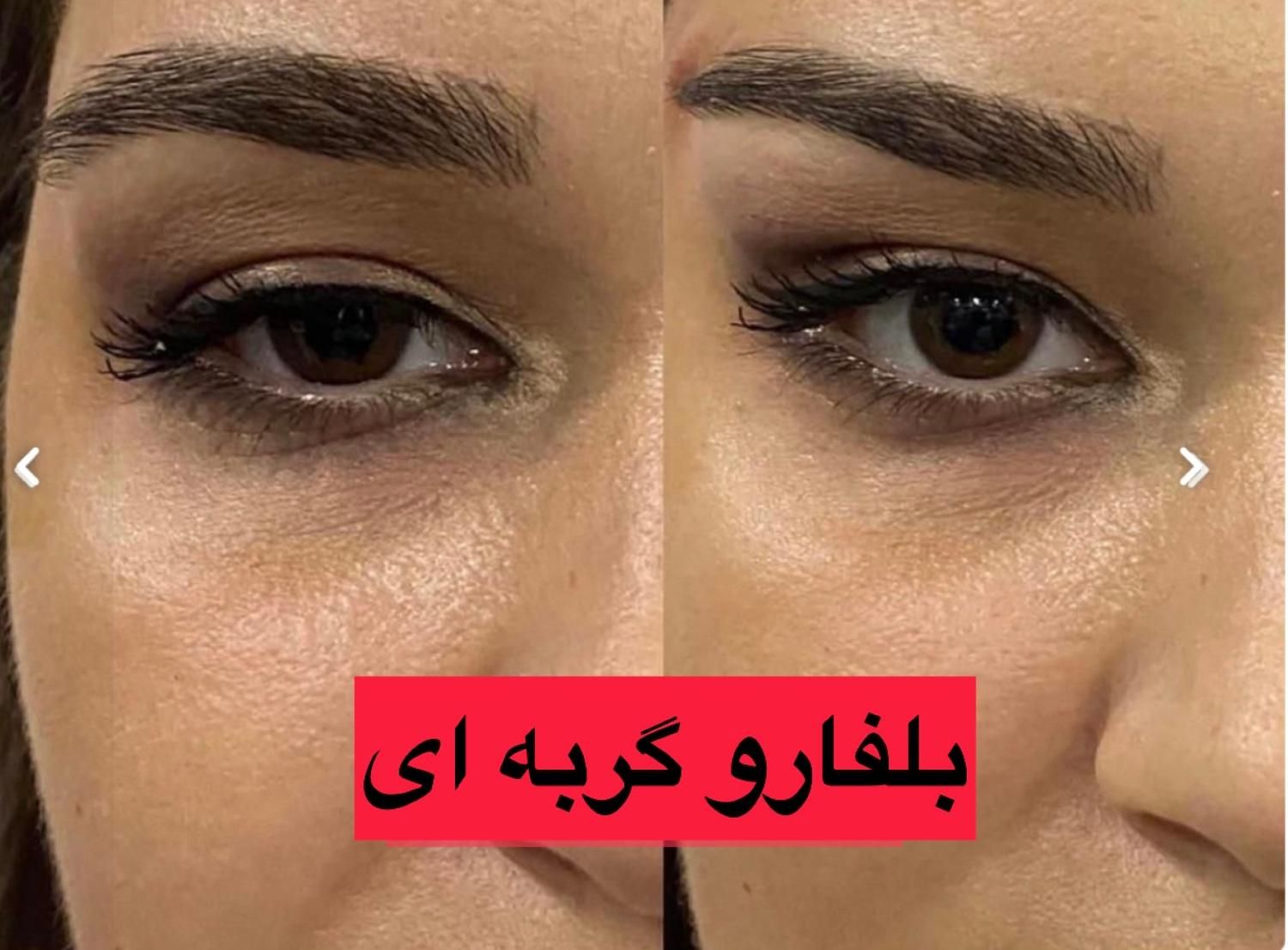 بلفاروپلاستی-سانترال لب-بوکال فت-ساکشن غبغب|خدمات آرایشگری و زیبایی|تهران, پاسداران|دیوار