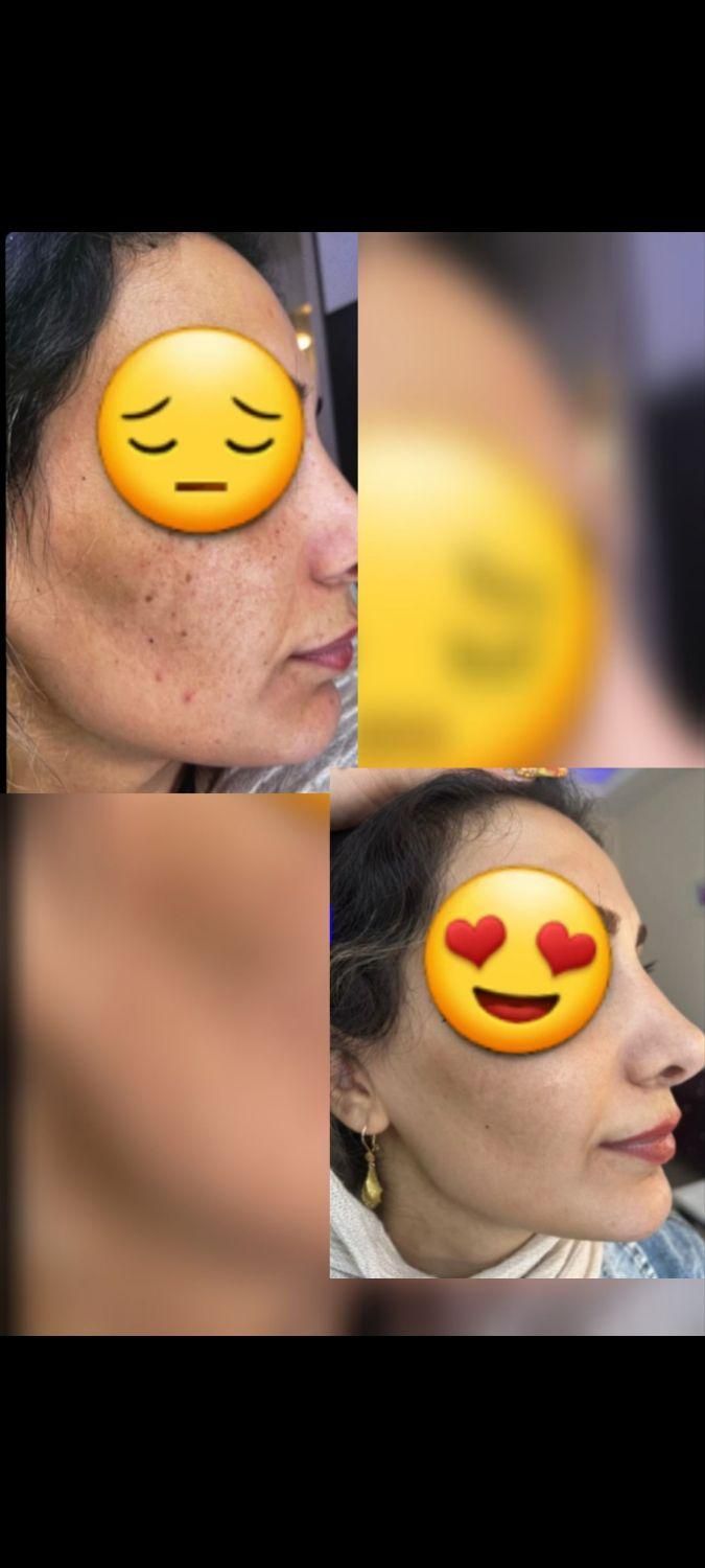 درمان تک جلسه ای تضمینی کک و مک ،لک،اسکار ،جوش|خدمات آرایشگری و زیبایی|قزوین, |دیوار