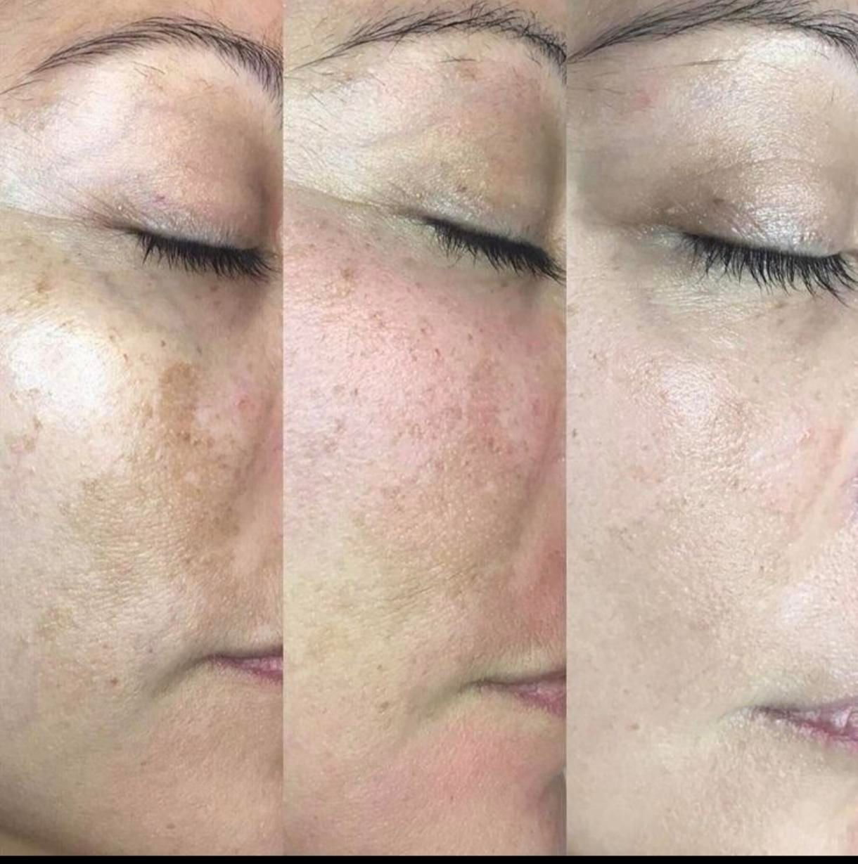 جشنواره هایفوتراپی vip همراه فیشال اشانتیون|خدمات آرایشگری و زیبایی|رشت, رودباری|دیوار