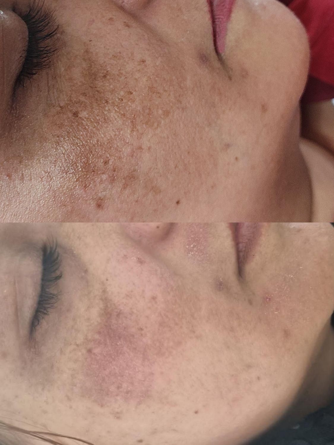 رفع کک و مک و لک . خال . اسکین تگ در یک جلسه|خدمات آرایشگری و زیبایی|بیرجند, |دیوار