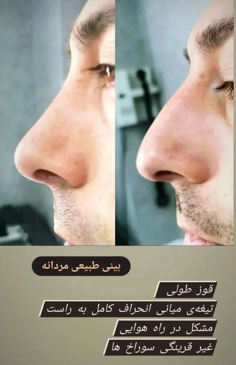 جراحی زیبایی بینی فقط با 22 ملیون|خدمات آرایشگری و زیبایی|شاهرود, |دیوار