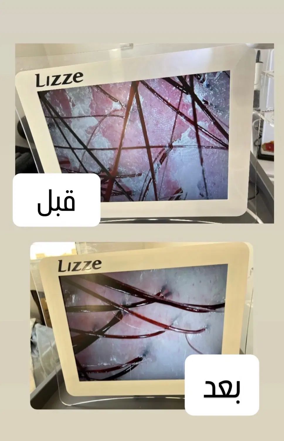 اسکراب اسکالپ(پاکسازی و درمان پوست سر)|خدمات آرایشگری و زیبایی|کرج, مطهری|دیوار