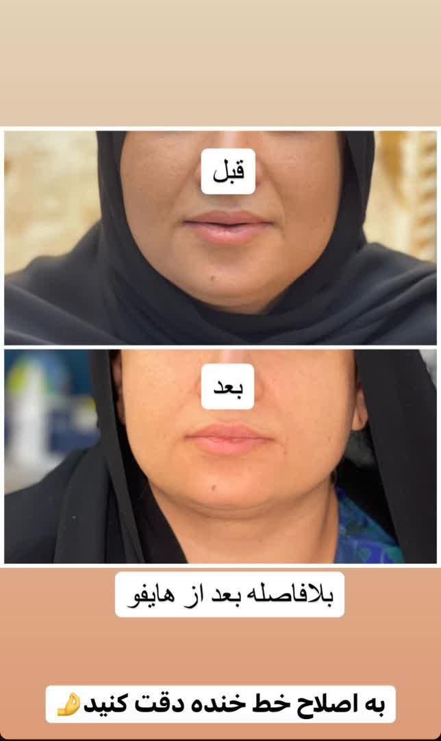 هایفوتراپی14بعدی برای نخستین بار در غرب کشور|خدمات آرایشگری و زیبایی|خرم‌آباد, |دیوار