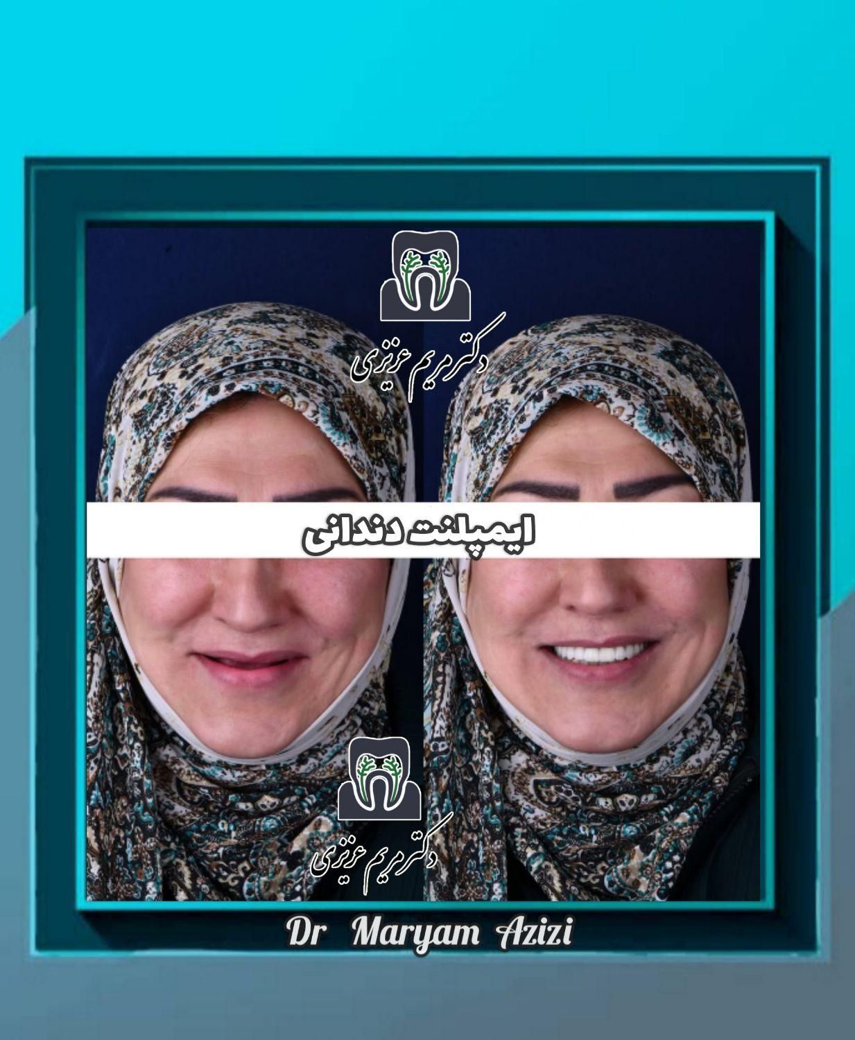 پایتخت ایمپلنت دندان دندانپزشکی تضمینی تعرفه دولتی|خدمات آرایشگری و زیبایی|شیراز, معالی‌آباد|دیوار