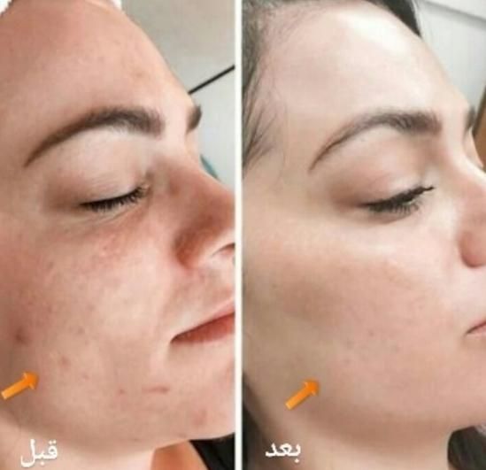 ۸۰درصد تخفیف در/لیزر/مزوتراپی/prp/جوانساز|خدمات آرایشگری و زیبایی|اندیشه, اندیشه فاز ۴|دیوار