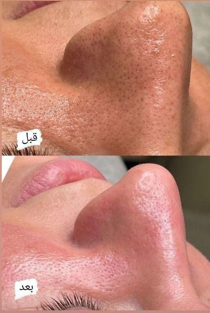 پاکسازی پوست بانوان|خدمات آرایشگری و زیبایی|اردبیل, |دیوار