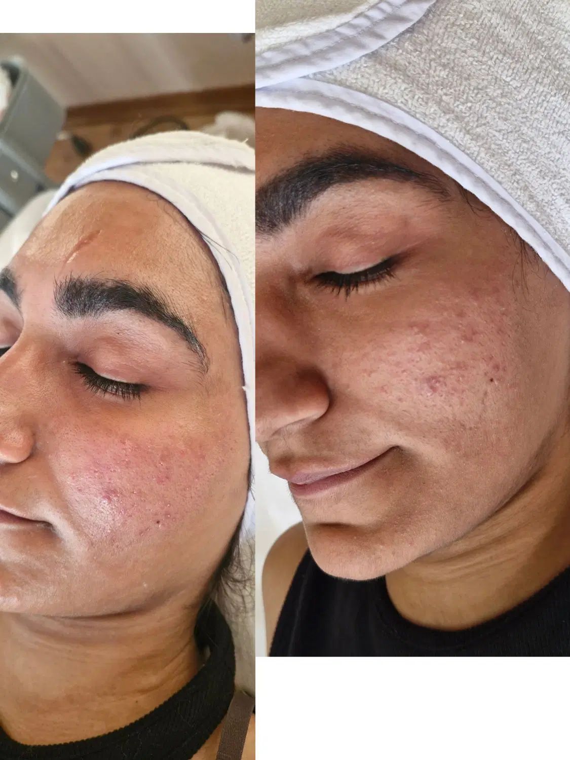 فیشال تخصصی ،پاکسازی پوست|خدمات آرایشگری و زیبایی|اصفهان, چشمه باقرخان|دیوار