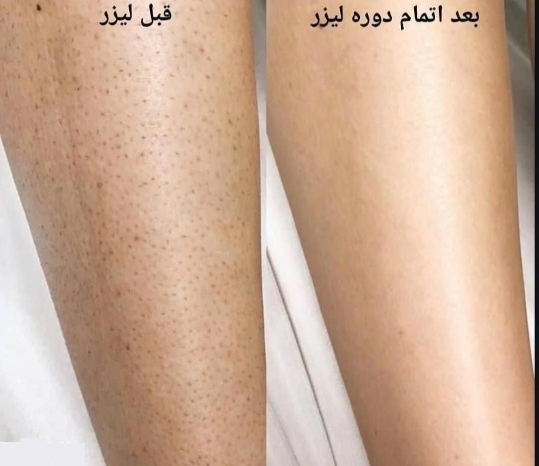 لیزرموهای زائد ویژه بانوان|خدمات آرایشگری و زیبایی|مشهد, توس (بلوار توس)|دیوار