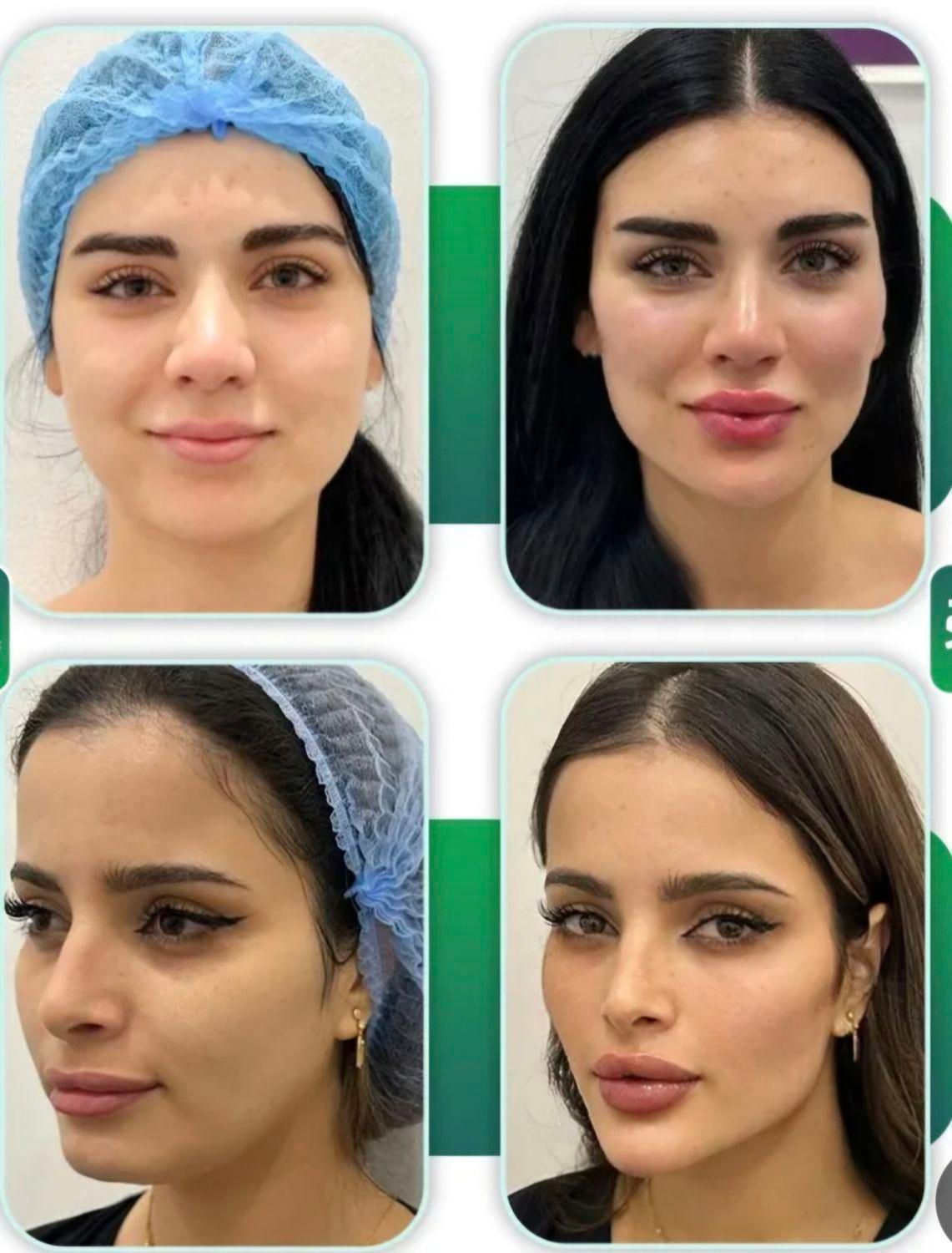 تزریق ژل،بوتاکس،سابسیژن،پی آرپی،مطب درمانی وزیبایی|خدمات آرایشگری و زیبایی|خرم‌آباد, |دیوار