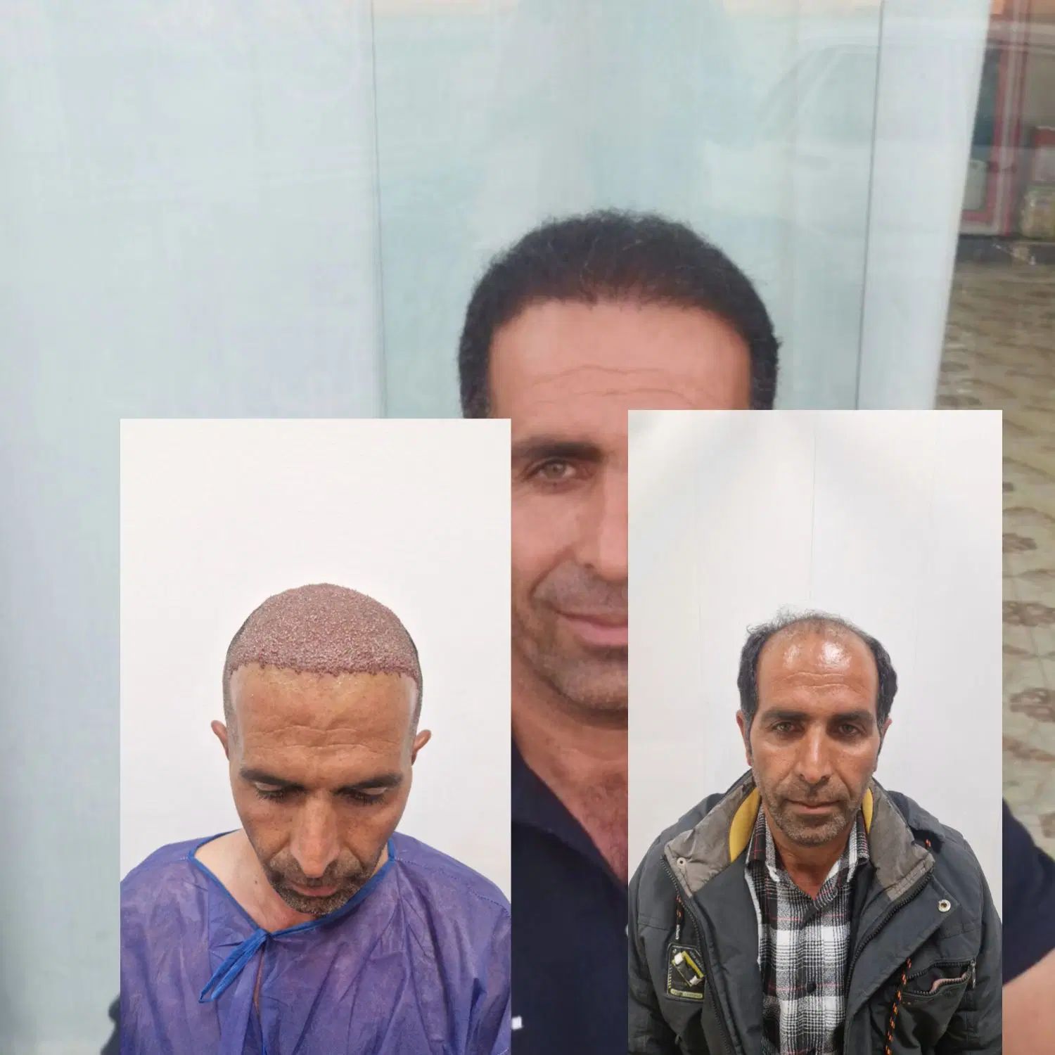 کاشتمو تضمینی و تراکم عالی زیر نظر پزشک|خدمات آرایشگری و زیبایی|مشهد, فردوسی|دیوار