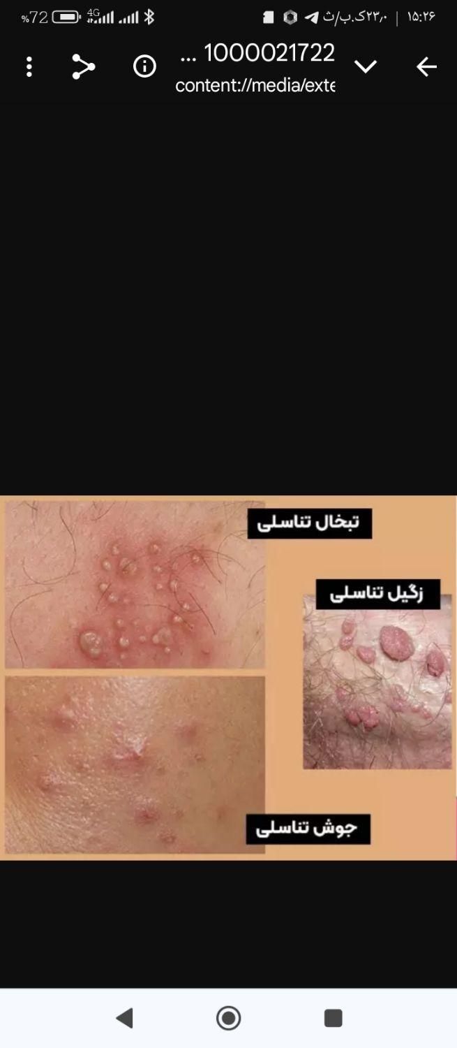 زگیل تناسلی|خدمات آرایشگری و زیبایی|تبریز, |دیوار