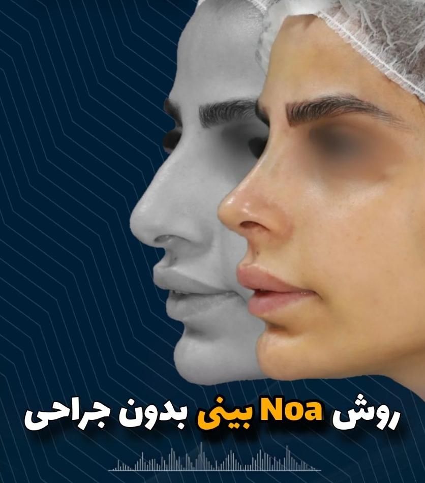 جشنواره کانتورینگ Pro Face بدون جراحی و بیهوشی|خدمات آرایشگری و زیبایی|مشهد, هفت تیر (حافظ)|دیوار