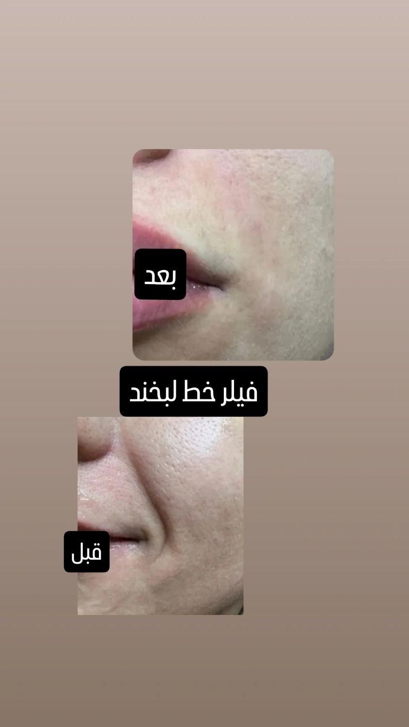 تزریق ژل با قیمت مناسب وبا کیفیت|خدمات آرایشگری و زیبایی|برازجان, |دیوار