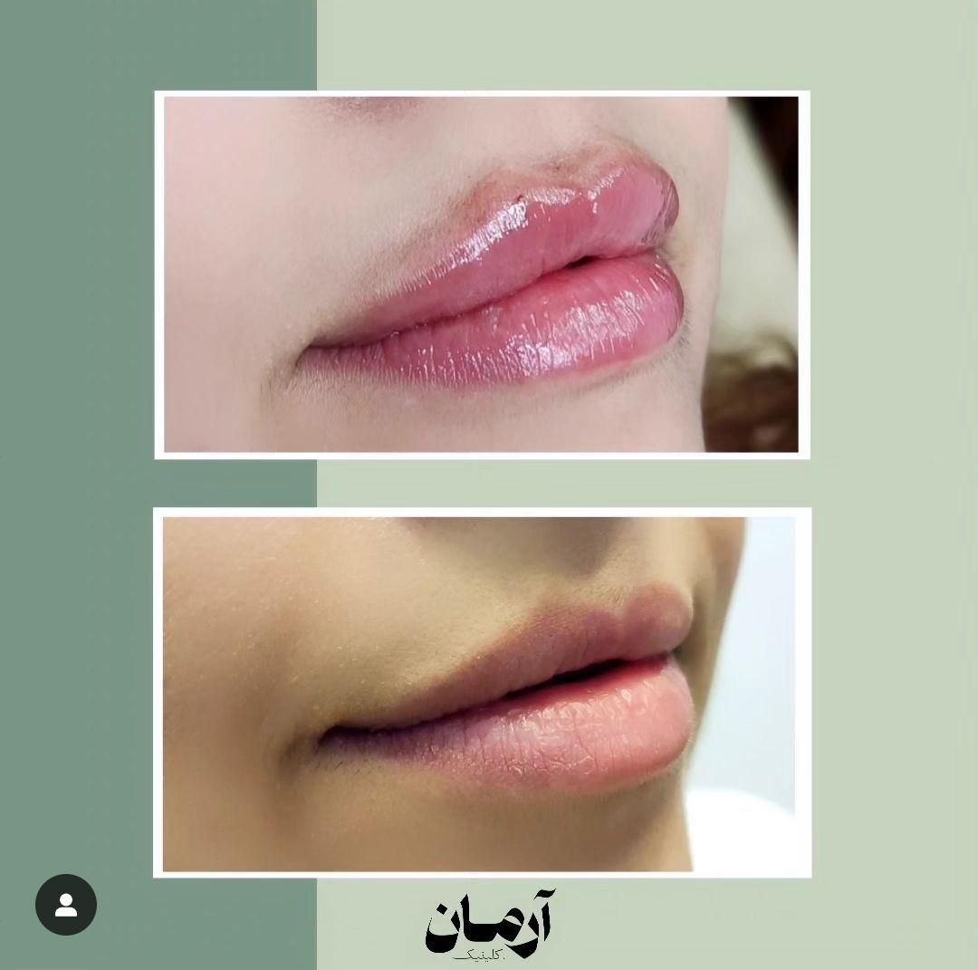 کانتورینگ با فیلر و ژل و لب تخصصی (کاملا طبیعی)|خدمات آرایشگری و زیبایی|مشهد, گلبرگ شمالی|دیوار