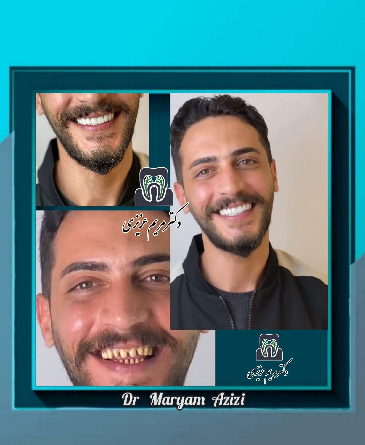 دندانپزشکی ترمیم دندان با مواد کامپوزیت دندان|خدمات آرایشگری و زیبایی|شیراز, معالی‌آباد|دیوار