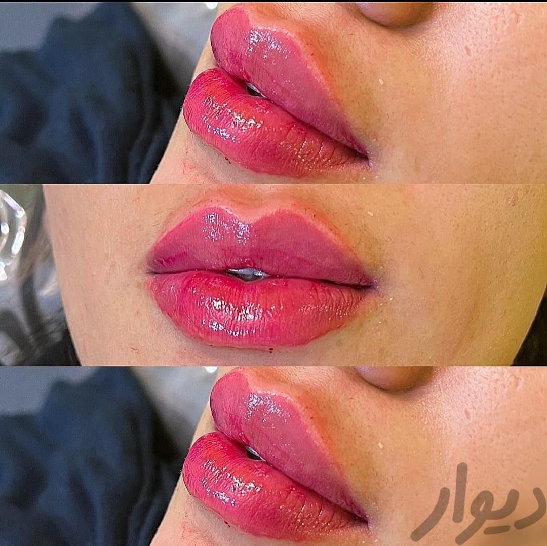 تزریق بوتاکس اصلی، ژل لب، خط خنده، زاویه فک وچانه|خدمات آرایشگری و زیبایی|ورامین, ورامین|دیوار