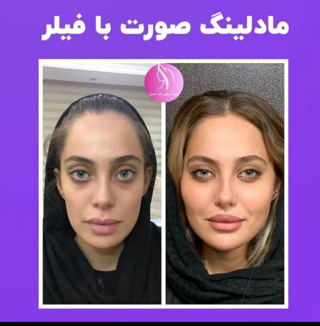 کلینیک لیزرمو بوتاکس تزریق  ژل لب روسی فیلر لیفت|خدمات آرایشگری و زیبایی|تهران, صادقیه|دیوار