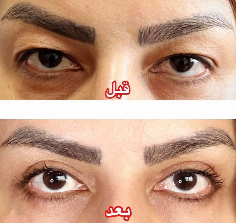 عمل پلک بالا بلفاروپلاستی|خدمات آرایشگری و زیبایی|شیراز, ملاصدرا|دیوار