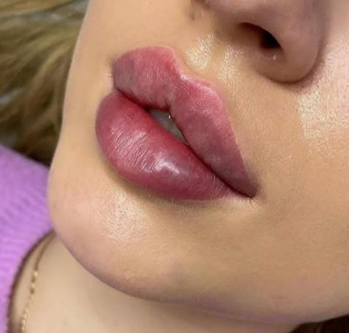 ژل لب بوتاکس پی آر پی آنزیم لیزر مو هایفو فشیال|خدمات آرایشگری و زیبایی|کرج, گوهردشت|دیوار