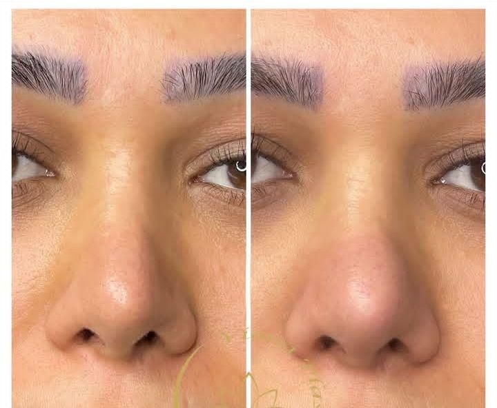 کوچک کردن بینی.رفع افتادگی‌پلک و چروک صورت|خدمات آرایشگری و زیبایی|زاهدان, |دیوار