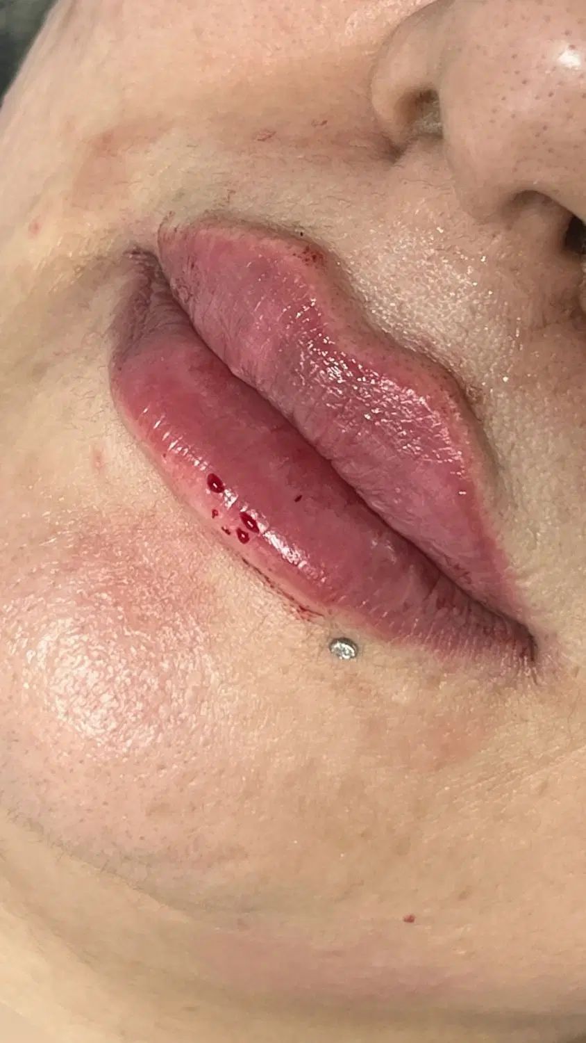 تزریق ژل و بوتاکس و مزو نیدلینگ و فیلر بادی|خدمات آرایشگری و زیبایی|امیدیه, |دیوار