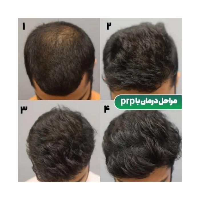 جشنواره پی آر پی prp در مطب پزشک|خدمات آرایشگری و زیبایی|اصفهان, برازنده|دیوار