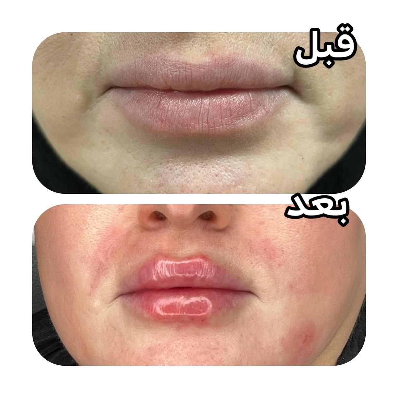 لیزر شاتی الکساندرایت نابلکس بوتاکس فیلر ژل نخ و .|خدمات آرایشگری و زیبایی|تهران, مشیریه|دیوار