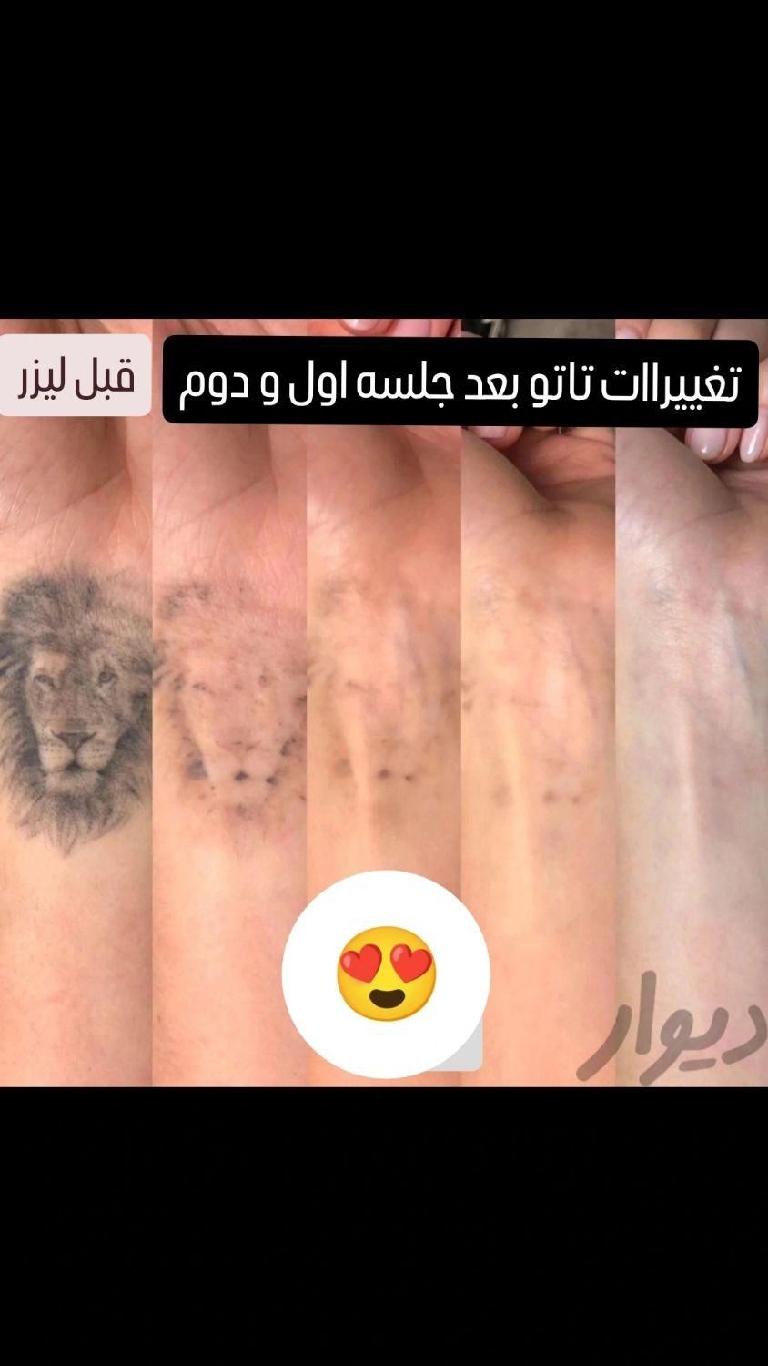 کلینیک تخصصی پاک کردن تتو با لیزر تضمینی/ریمو ابرو|خدمات آرایشگری و زیبایی|مشهد, کوثر|دیوار