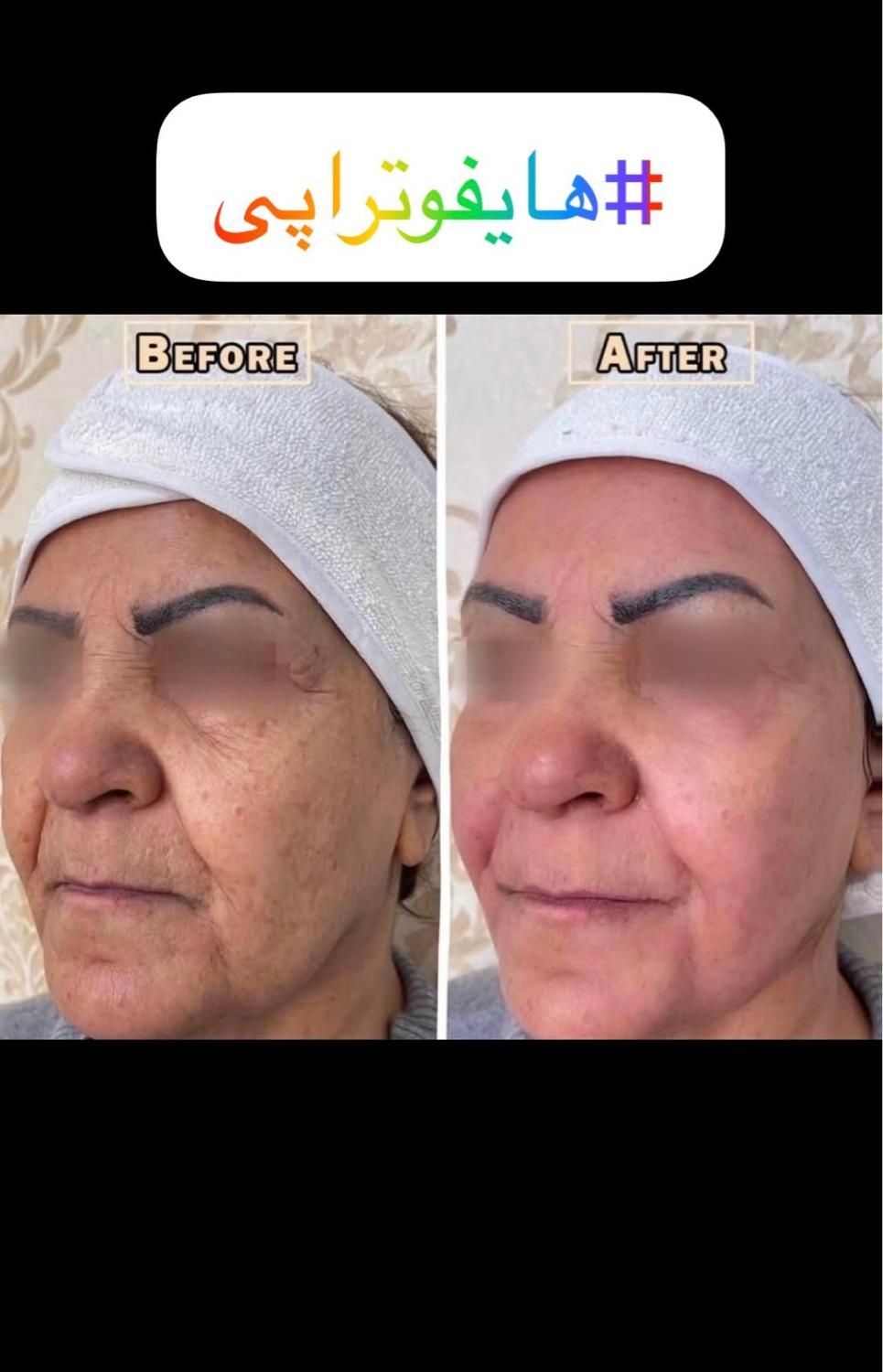 هایفو تراپی/پلاژن تراپی/کربوکسی/لیزربدن|خدمات آرایشگری و زیبایی|مشهد, محمدآباد|دیوار