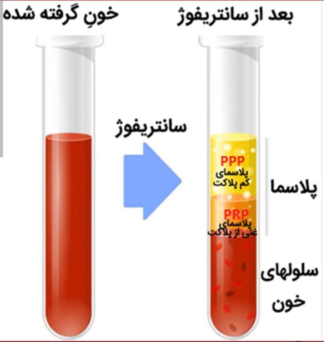 prp پی ارپی مو صورت... مطب دکتر صادقیه|خدمات آرایشگری و زیبایی|تهران, فردوس|دیوار